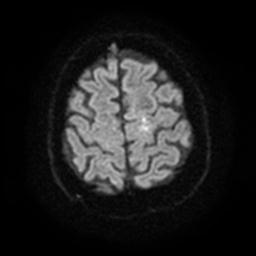 Cerebral amyloid angiopathy (Radiopaedia 28698-28978 Axial DWI 25).jpg