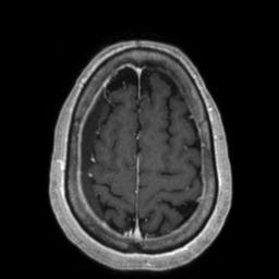 Cerebral amyloid angiopathy (Radiopaedia 29129-29518 Axial T1 C+ 123).jpg