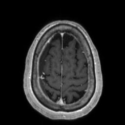File:Cerebral amyloid angiopathy (Radiopaedia 29129-29518 Axial T1 C+ 127).jpg