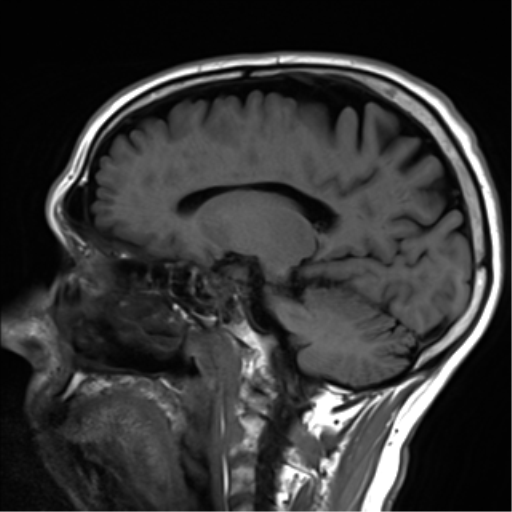 File:Cerebral amyloid angiopathy (Radiopaedia 46082-50433 Sagittal T1 17).png
