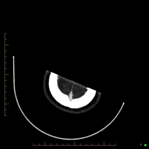 Cerebral arteriovenous malformation (AVM) (Radiopaedia 78162-90706 Axial CTA 249).jpg