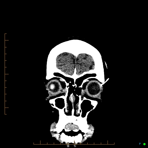 Cerebral arteriovenous malformation (AVM) (Radiopaedia 78162-90706 Coronal non-contrast 13).jpg