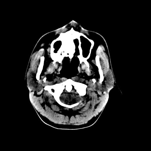 Cerebral arteriovenous malformation (Radiopaedia 28518-28759 Axial non-contrast 1).jpg