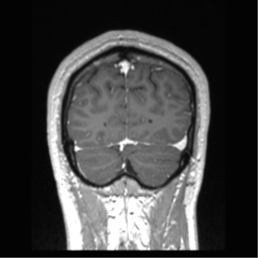 Cerebral arteriovenous malformation (Radiopaedia 39259-41506 Coronal T1 C+ 18).png