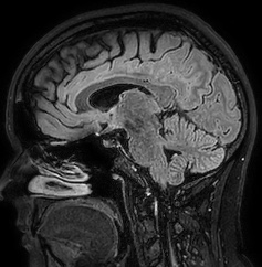 Cerebral arteriovenous malformation (Radiopaedia 74411-85654 Sagittal FLAIR 56).jpg