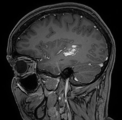 Cerebral arteriovenous malformation (Radiopaedia 74411-85654 Sagittal T1 C+ 34).jpg