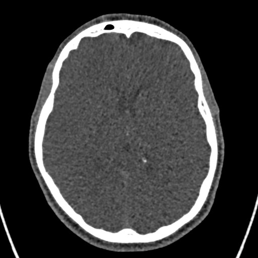 Cerebral arteriovenous malformation (Radiopaedia 78188-90746 Axial non-contrast 99).jpg