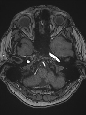 File:Cerebral arteriovenous malformation (Radiopaedia 84015-99245 Axial TOF 66).jpg