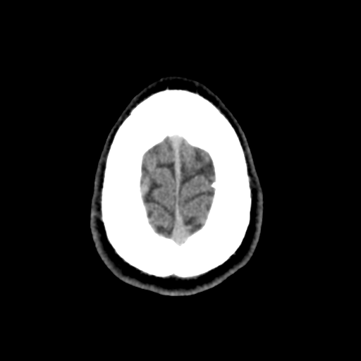 Cerebral arteriovenous malformation (Spetzler-Martin grade 2) (Radiopaedia 41262-44076 Axial non-contrast 51).png