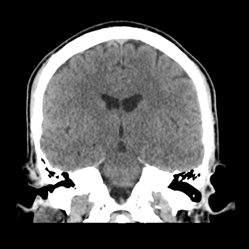 Cerebral arteriovenous malformation (Spetzler-Martin grade 2) (Radiopaedia 41262-44076 Coronal non-contrast 32).png