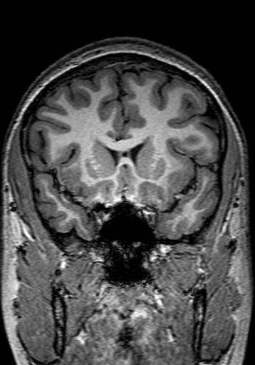 File:Cerebral arteriovenous malformation at posterior body of corpus callosum (Radiopaedia 74111-84925 Coronal T1 105).jpg