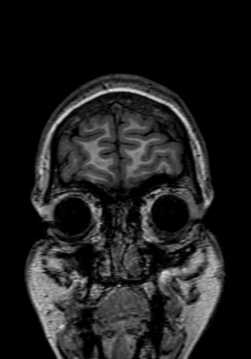 Cerebral arteriovenous malformation at posterior body of corpus callosum (Radiopaedia 74111-84925 Coronal T1 7).jpg