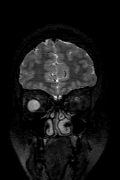 Cerebral arteriovenous malformation at posterior body of corpus callosum (Radiopaedia 74111-84925 Coronal T2 26).jpg