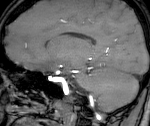 Cerebral arteriovenous malformation at posterior body of corpus callosum (Radiopaedia 74111-84925 J 235).jpg