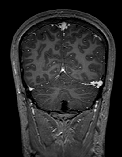 Cerebral arteriovenous malformation at posterior body of corpus callosum (Radiopaedia 74111-84925 K 295).jpg