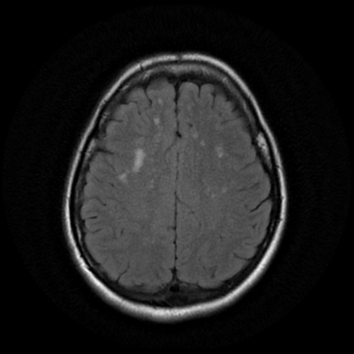File:Cerebral autosomal dominant arteriopathy with subcortical infarcts and leukoencephalopathy (CADASIL) (Radiopaedia 41018-43768 AX FLAIR (Propeller) 15).png