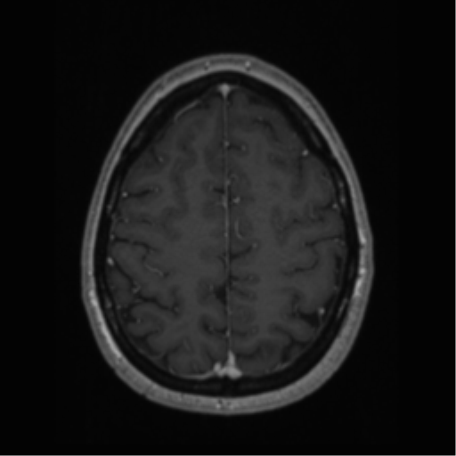 Cerebral cavernoma and development venous anomaly (Radiopaedia 37603-39482 Axial T1 C+ 59).png