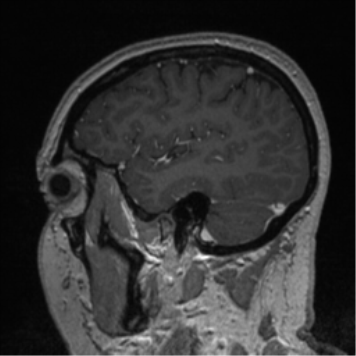 Cerebral cavernoma and development venous anomaly (Radiopaedia 37603-39482 Sagittal T1 C+ 73).png