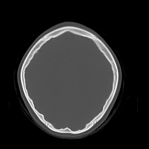 Cerebral cavernous venous malformation (Radiopaedia 70008-80022 Axial bone window 38).jpg