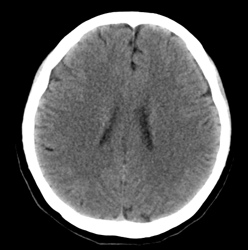File:Cerebral cavernous venous malformations (Radiopaedia 48117-52945 Axial non-contrast 21).png