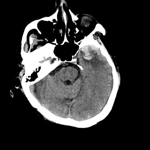 File:Cerebral contusions, subarachnoid hemorrhage and subdural hygromas (Radiopaedia 55399-61830 Axial non-contrast 10).png