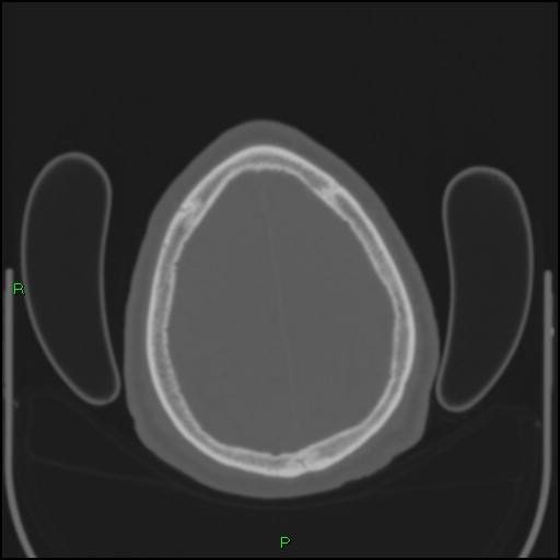 File:Cerebral contusions (Radiopaedia 33868-35039 Axial bone window 187).jpg