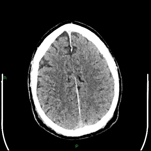 File:Cerebral contusions (Radiopaedia 33868-35039 Axial non-contrast 158).jpg