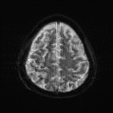 Cerebral embolic infarcts (embolic shower) (Radiopaedia 72391-82921 Axial DWI 24).jpg