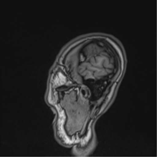 Cerebral fat embolism (Radiopaedia 57697-64639 Sagittal T1 11).png