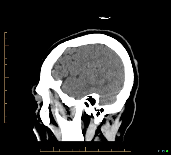 Cerebral fat embolism (Radiopaedia 85521-101220 B 44).jpg