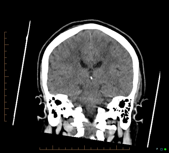 Cerebral fat embolism (Radiopaedia 85521-101220 Coronal non-contrast 38).jpg