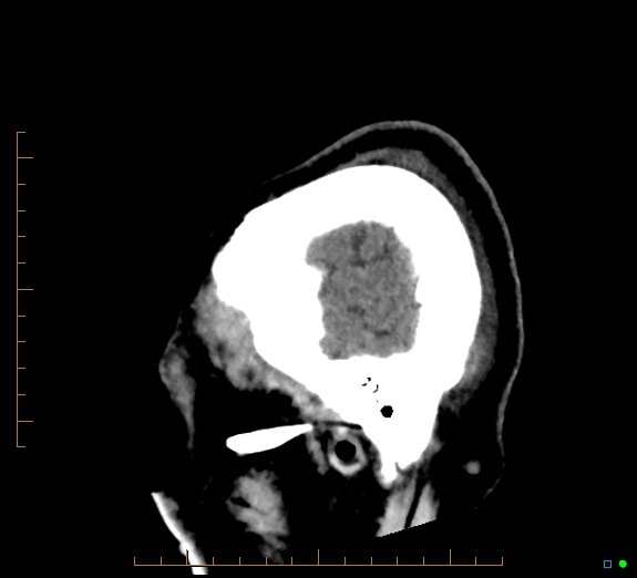 Cerebral fat embolism (Radiopaedia 85521-101224 C 5).jpg