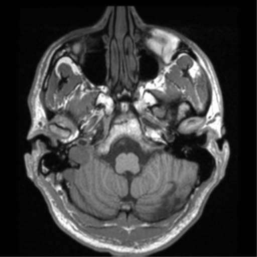 File:Cerebral hemorrhagic contusions- temporal evolution (Radiopaedia 40224-42757 Axial T1 14).png