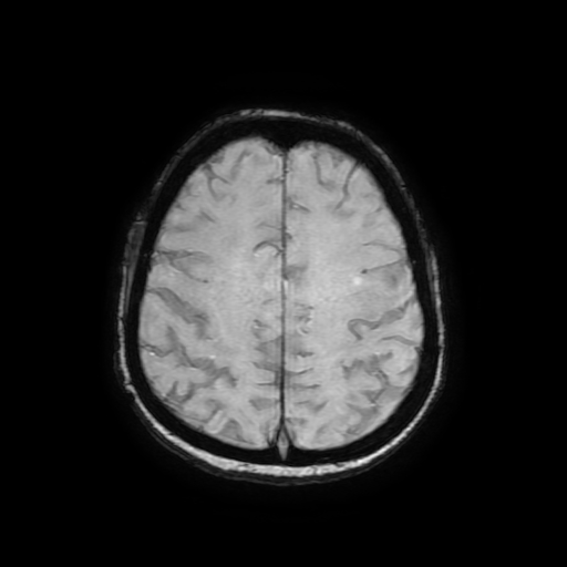 Cerebral metastases - melanoma (Radiopaedia 80972-94522 Axial SWI 73).jpg