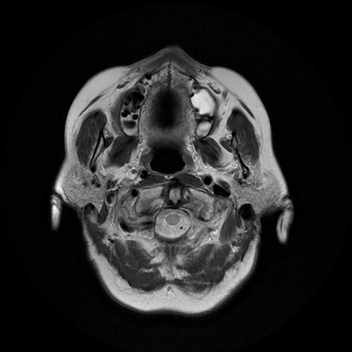 File:Cerebral metastases - melanoma (Radiopaedia 80972-94522 Axial T2 2).jpg