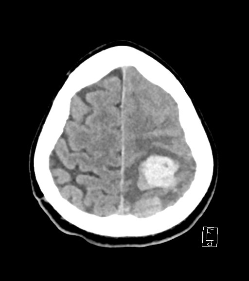 Cerebral metastases - testicular choriocarcinoma (Radiopaedia 84486-99855 Axial non-contrast 13).jpg