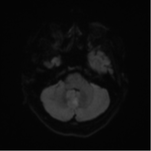 Cerebral metastases mimicking abscesses (Radiopaedia 45841-50131 Axial DWI 36).png