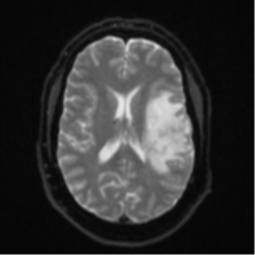 Cerebral metastases mimicking multifocal glioblastoma (Radiopaedia 50843-56353 Axial DWI 16).png