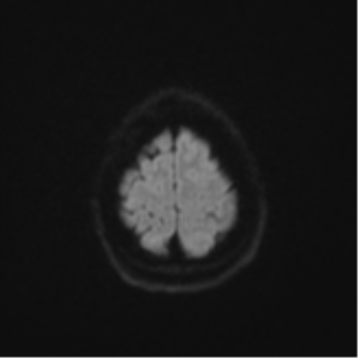 Cerebral metastasis (Radiopaedia 46744-51248 Axial DWI 53).png