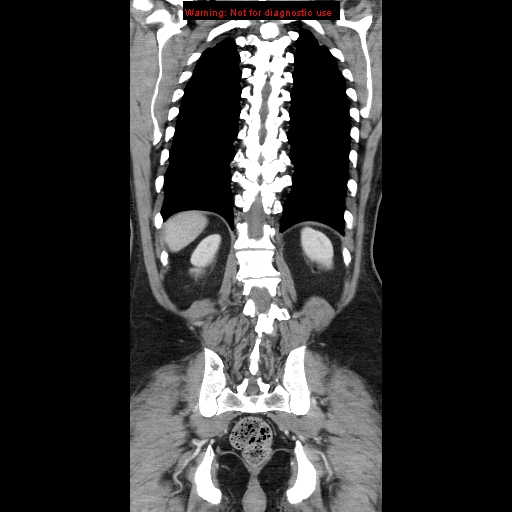 Cerebral metastasis - colorectal carcinoma (Radiopaedia 8581-83548 A 66).jpg