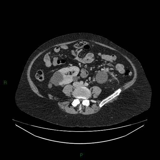File:Cerebral metastasis from renal cell carcinoma (Radiopaedia 82306-96378 A 111).jpg