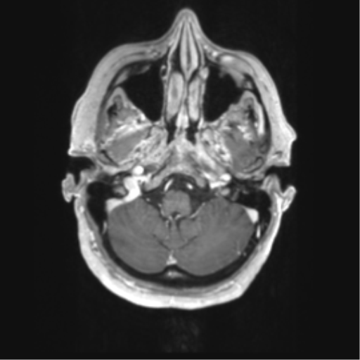 File:Cerebral metastasis mimicking glioblastoma (Radiopaedia 69155-78937 Axial T1 C+ 7).png