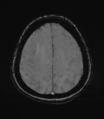File:Cerebral metastasis to basal ganglia (Radiopaedia 81568-95413 Axial SWI 68).png