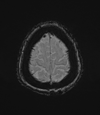 Cerebral metastasis to basal ganglia (Radiopaedia 81568-95413 Axial SWI 79).png