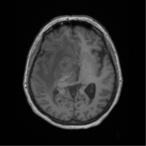 Cerebral metastasis to basal ganglia (Radiopaedia 81568-95413 Axial T1 34).png