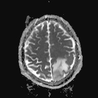 File:Cerebral toxoplasmosis (Radiopaedia 43956-47461 Axial ADC 16).jpg