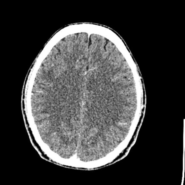 File:Cerebral toxoplasmosis (Radiopaedia 53993-60131 Axial C+ delayed 49).jpg