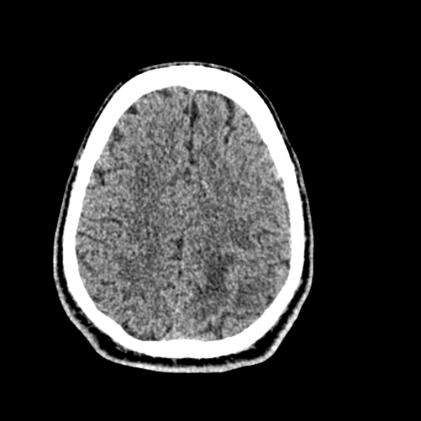 File:Cerebral toxoplasmosis (Radiopaedia 53993-60131 Axial non-contrast 61).jpg