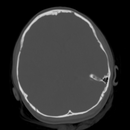 Cerebral tuberculosis with dural sinus invasion (Radiopaedia 60353-68018 Axial bone window 21).jpg