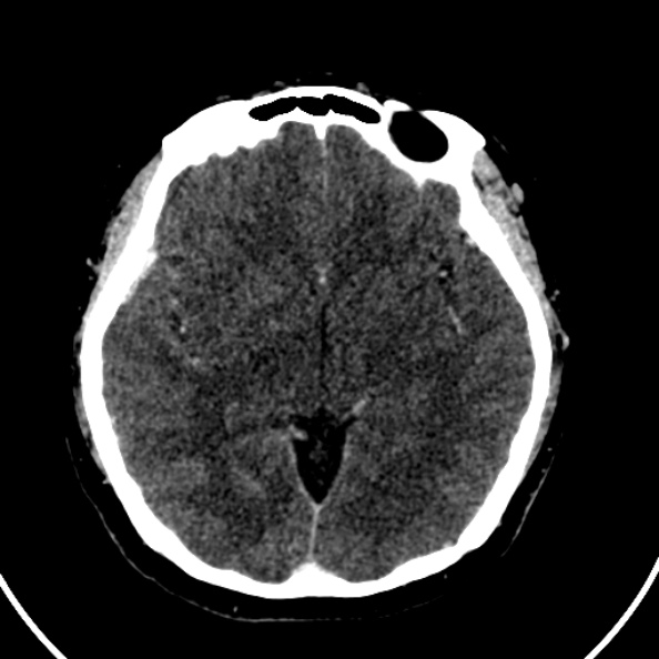 Cerebral venous hemorrhagic infarct from venous sinus thrombosis (Radiopaedia 55433-61883 Axial C+ delayed 83).jpg